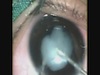 Transcorneal Lensectomy