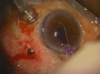 Endophthalmitis