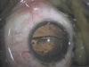 Complications of Phakic Lenses: Intra-Operative