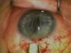 Pupil Stretching