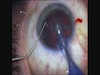 Cataract Surgery in Fuchs' Iridocyclitis