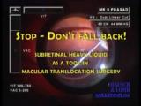 Stop, Dont Fall Back! The Use of Subretinal  PFCL 