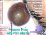 Visco-Dissection Technique for Posterior Polar Cataract