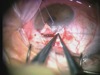 Tips for Successful Canaloplasty