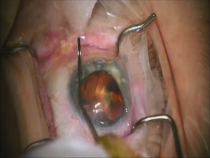 iStent Placement Prior to Cataract Extraction
