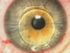 ARTIFLEX PIOL Implantation Technique
