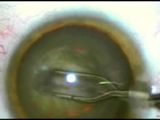 Single Incision Cataract Surgery with Dr. Trindade