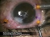 A Shot in the Dark: Vitrectomy for Severe Ocular Trauma