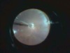 Vitrectomy for Optic Nerve Pit