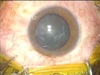 Twenty-seven Gauge Vitrectomy for Proliferative Diabetic Retinopathy