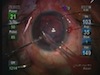 Using Sandwich Phaco in Small Pupil Case