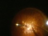 Refloating Posterior Luxated Intraocular Lenses Using the Vitreotome
