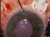 McCannel Suture Technique