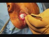 Implantation of Orbtex Bio-ceramic Orbital Implant Following Enucleation of a Blind, Painful Globe Near Rupture