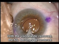 Why is this IOL De-Centered? The Answer