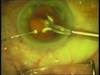 Corneal On-Demand Irrigation System