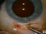Gape Closure