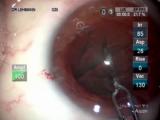 Torsional Phaco and ReSTOR Implantation