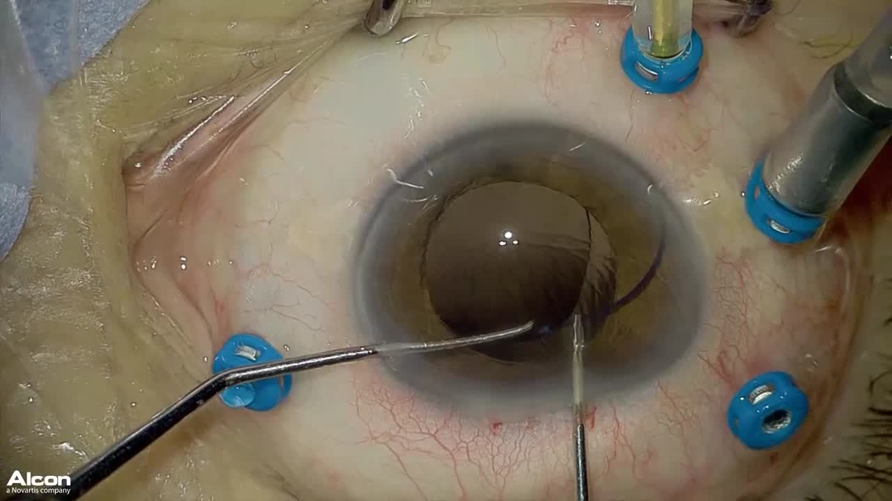 IOL Insertion