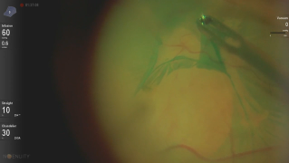 3D Visualization and Sharkskin Forceps for Epiretinal and Internal Liminiting Membrane Peeling