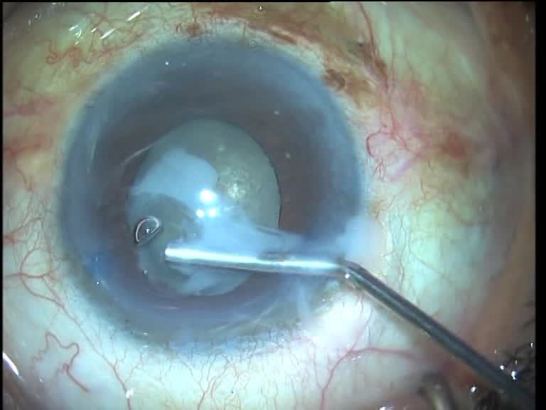 Cataract Surgery in a White Morgagnian Cataract 