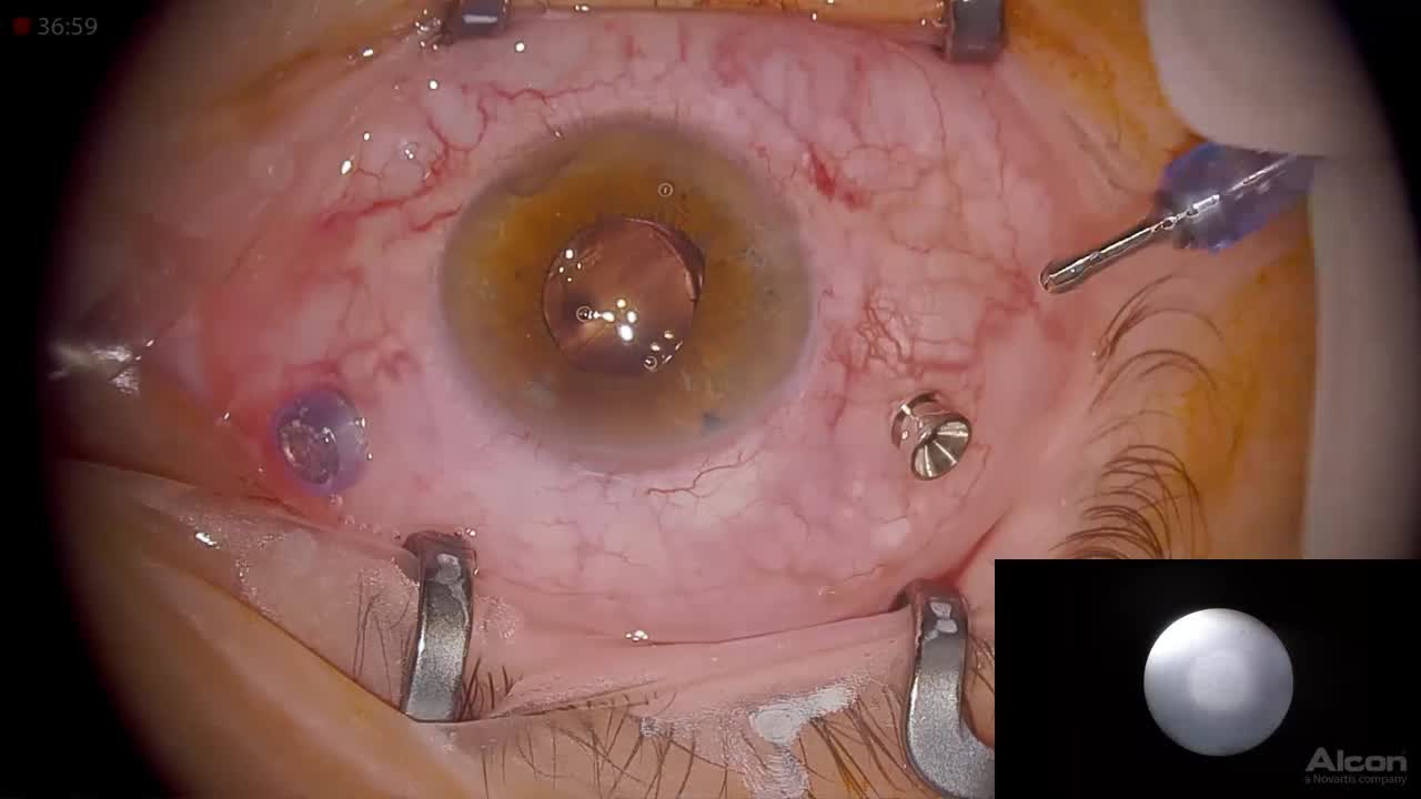 Choroidal Detachment