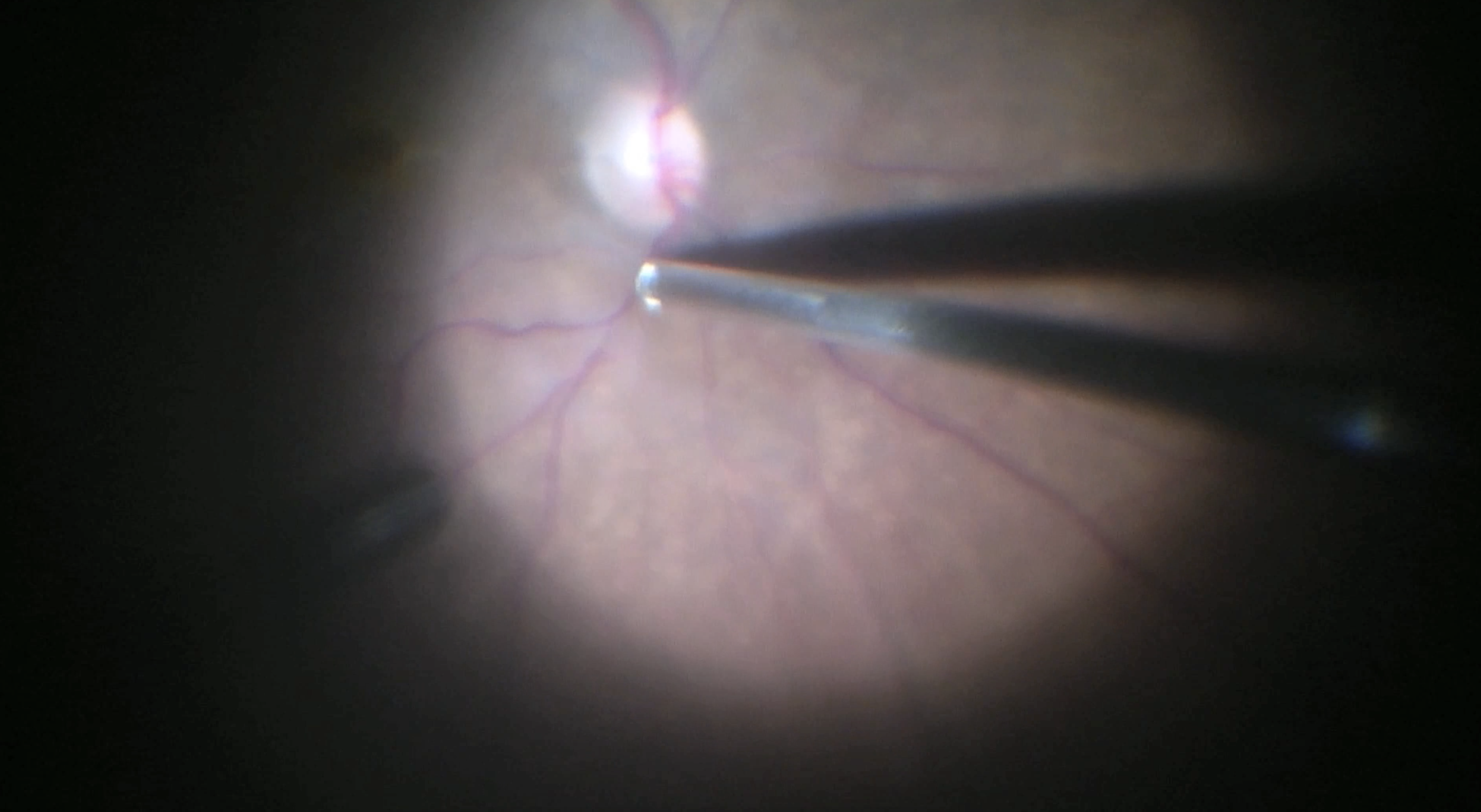 Vitrectomy With Cutter-only ILM Peel During Full-thickness Macular Hole Surgery