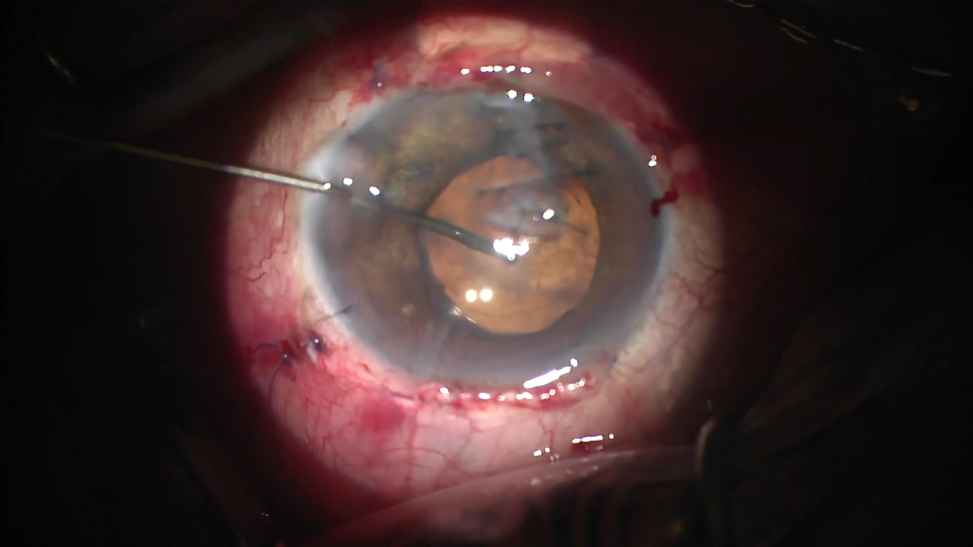 Uveal Extrusion and High IOP After Cataract Surgery