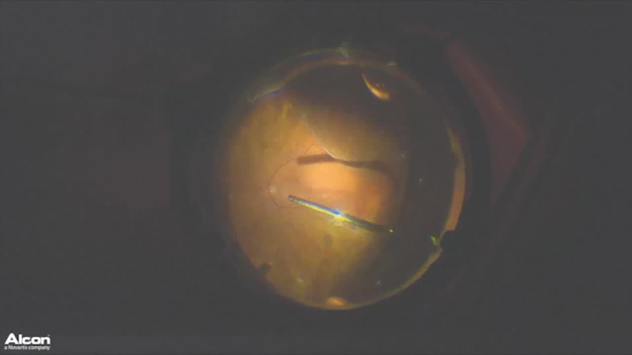 Choroidal Detachment