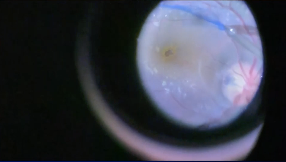 Optic Nerve Pit