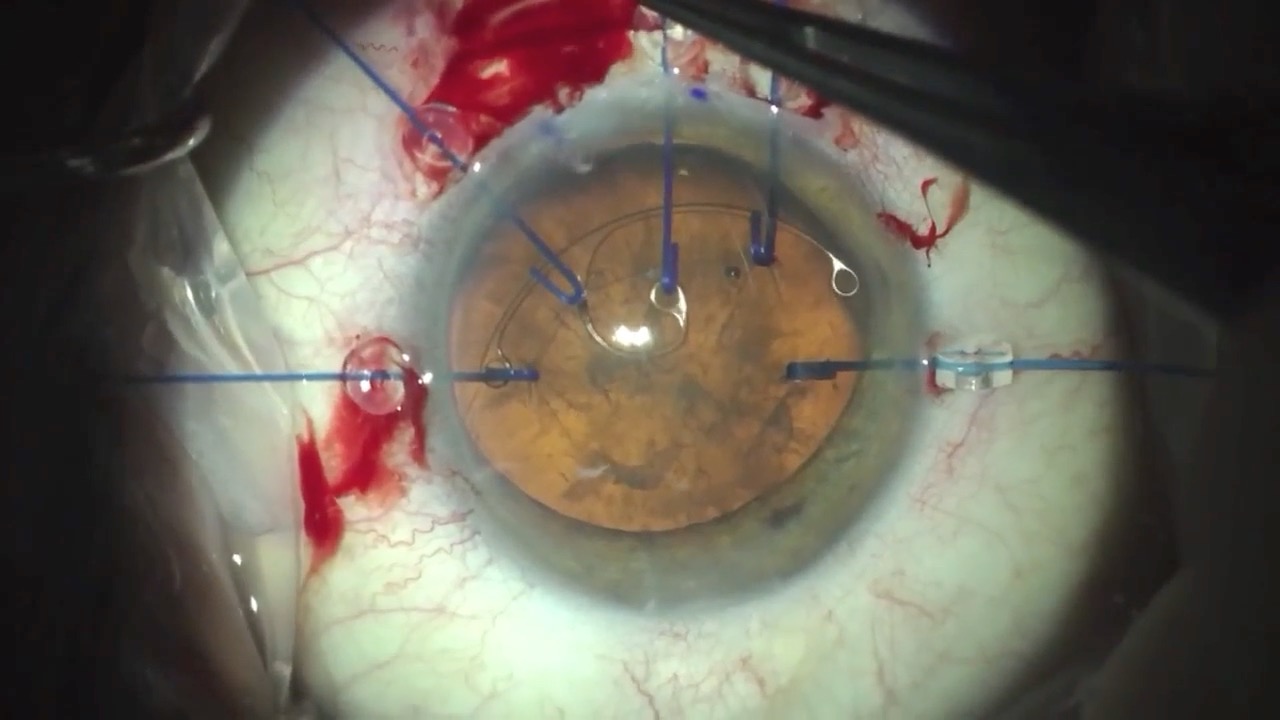 Severe Zonular Weakness and Advanced Cataract Surgery