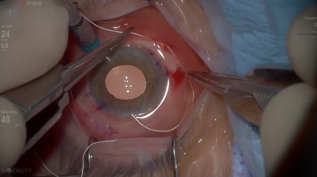 MX60 enVista Secondary IOL Scleral Fixation