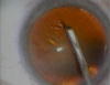 Capsulorhexis Tricks