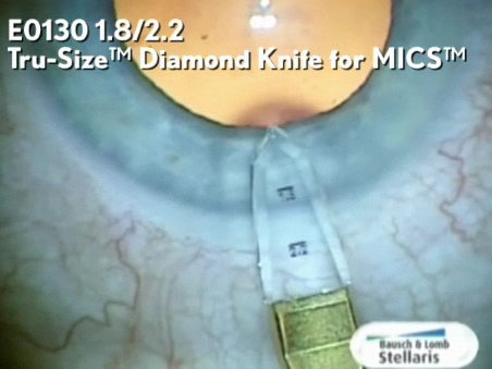 TruSize Diamond Knife for MICS