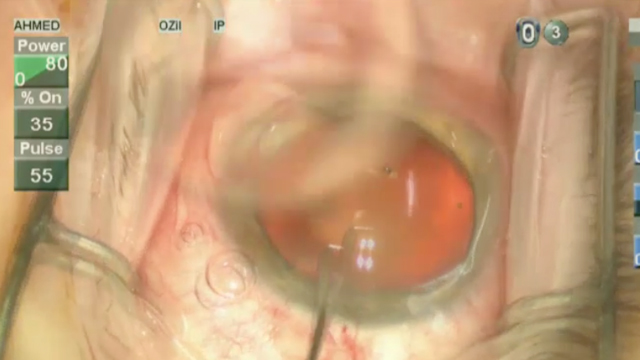 iStent Trabecular Microbypass Implantation Technique