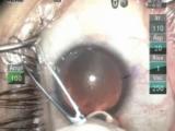 Using the Mackool Capsulorhexis Forceps 