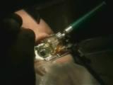 My way to Epi-LASIK