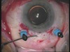 DORC Forceps for ISFPCIOL