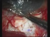 Dr. Agarwal's Eye Hospital - Rotational flap for trabeculectomy bleb leak