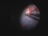 Technique of ILM peeling in detached retina without PFCL aid