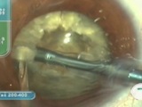 MicroChop for Hard Cataract