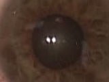 Anterior Chamber Worm
