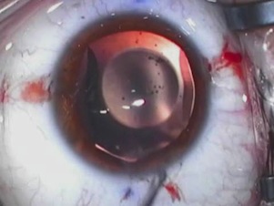 Visian ICL Implantation