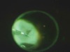 ROP and Avastin