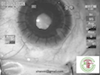 Combined Phacoemulsification and EX-PRESS Glaucoma Device Implantation
