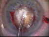 Piercing the Darkness - Cataract Surgery on a Blind Eye