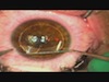 Refractive Surgery With the 500-Hz Excimer Laser 