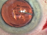 Removal of Silicone Oil from an IOL using the “Hydraulic Squeegee”