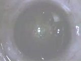 Zeimer FEMTO LDV flap in Post RK eye