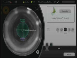 Improving Centration With OCT-Guided Laser Capsulotomy